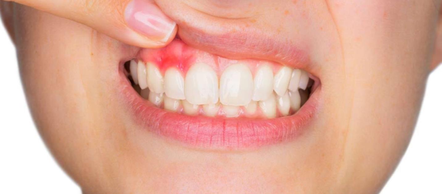 Ointment for gums from inflammation. Treatment of gingivitis Ointment for gums from inflammation. Treatment of gingivitis
