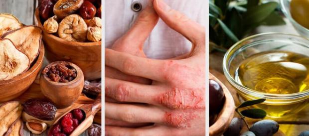 Dermatite atópica: acabe com as coceiras com esses tratamentos naturais Dermatite atópica: acabe com as coceiras com esses tratamentos naturais
