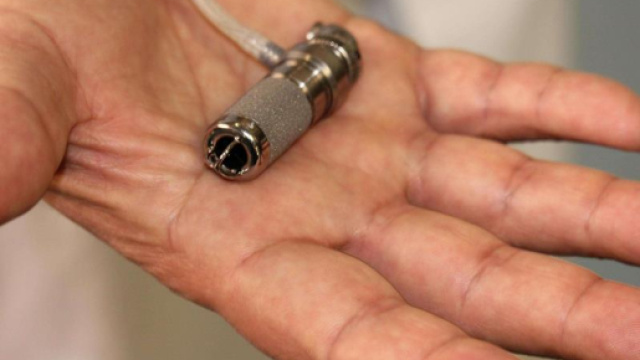 Mini-cuore artificiale salva bimba di 3 anni