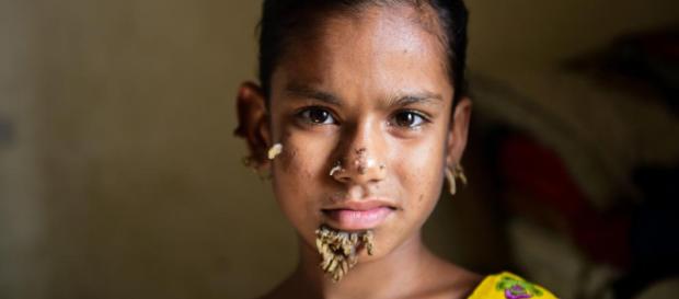 Una niña de Bangladesh sufre del terrible síntoma del “hombre ... - i24web.com Una niña de Bangladesh sufre del terrible síntoma del “hombre ... - i24web.com