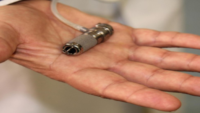 Minicuore impiantato sulla giovane paziente.