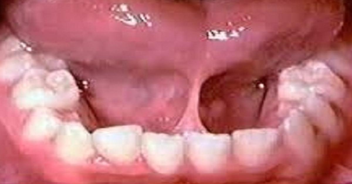 ¿Deberían o no cortarle el frenillo lingual a mi hijo?
