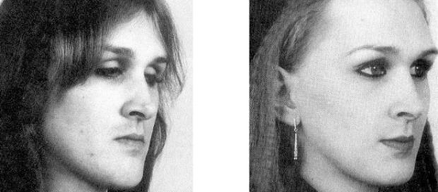 Cirugía estética feminizante en transexuales - Dr. Sarmentero - doctorsarmentero.com Cirugía estética feminizante en transexuales - Dr. Sarmentero - doctorsarmentero.com