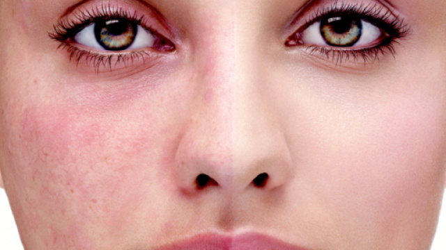 un viso con imperfezioni varie.