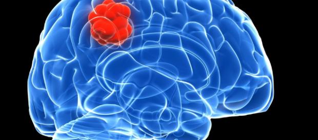 La obesidad aumenta el riesgo de tumores cerebrales - muyinteresante.es La obesidad aumenta el riesgo de tumores cerebrales - muyinteresante.es