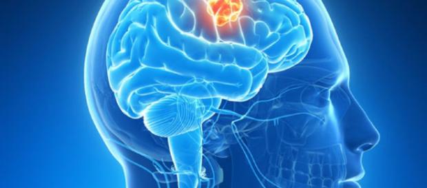Mecanismo clave en formación de tumores cerebrales | Cánce - com.uy Mecanismo clave en formación de tumores cerebrales | Cánce - com.uy