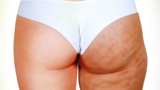 Che cos'&egrave; la cellulite? Ecco come curarla