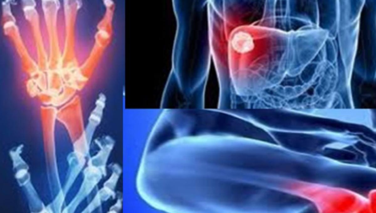 Tratamiento artritis reumatoide en ancianos