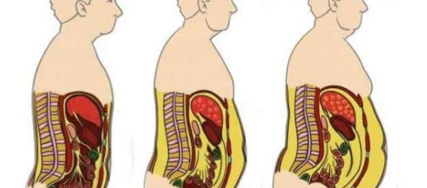Algunos genes serían responsables de la grasa en la cintura, la diabetes y la hipercolesterolemia. Algunos genes serían responsables de la grasa en la cintura, la diabetes y la hipercolesterolemia.