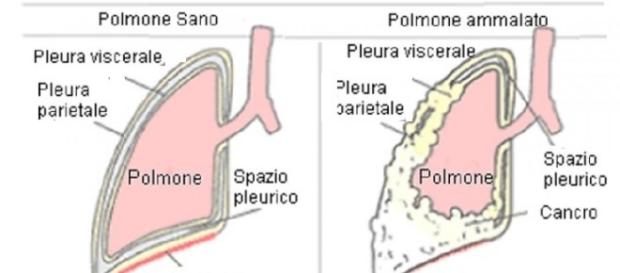 El inhibidor nivolumab PD-1 también funciona en el mesotelioma pleural El inhibidor nivolumab PD-1 también funciona en el mesotelioma pleural