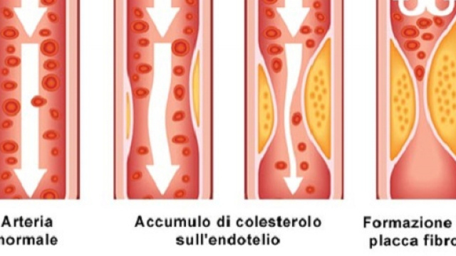 Una terapia genica risolver&agrave; il problema del colesterolo alto per sempre