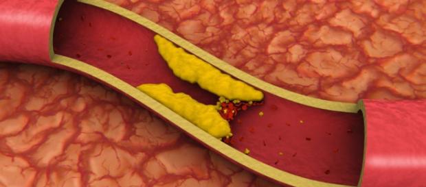 Un alimento se consumato tutti i giorni previene ictus e infarto Un alimento se consumato tutti i giorni previene ictus e infarto