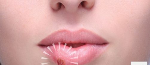 Simple consejos pueden evitar esta lesión desagradable en la boca. El herpes no tiene cura, pero tiene tratamiento