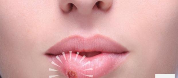 Simple consejos pueden evitar esta lesión desagradable en la boca. El herpes no tiene cura, pero tiene tratamiento Simple consejos pueden evitar esta lesión desagradable en la boca. El herpes no tiene cura, pero tiene tratamiento