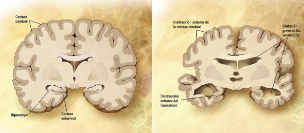 Enfermedad de Alzheimer - Wikipedia, la enciclopedia libre - wikipedia.org Enfermedad de Alzheimer - Wikipedia, la enciclopedia libre - wikipedia.org