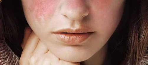 Lupus: ¿Se puede prevenir? ¿Existe algún tratamiento?