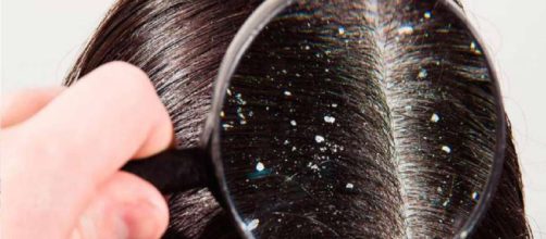 Los 5 mejores productos para eliminar la caspa del cabello | El ... - eldiariony.com