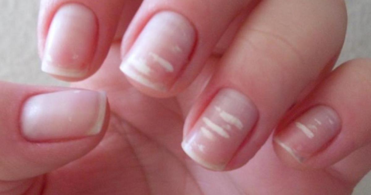 ¿que Son Las Manchas Blancas Que Aparecen En Las Uñas Aprenda Lo Queemk 8870