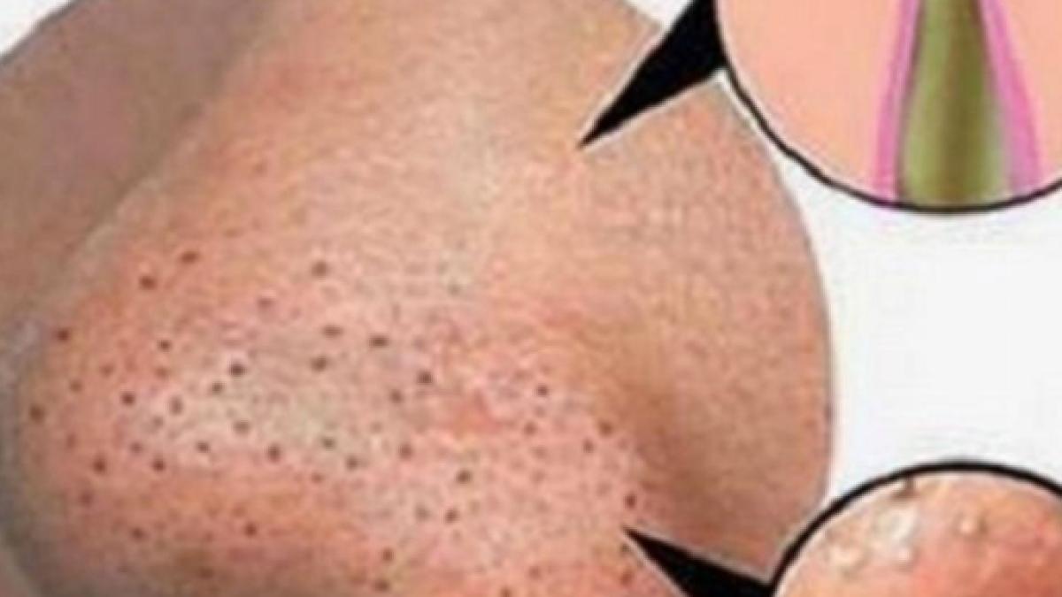 Como Quitar Espinillas Negras De La Nariz Cómo eliminar las espinillas de la nariz: el remedio grotesco de Jacob