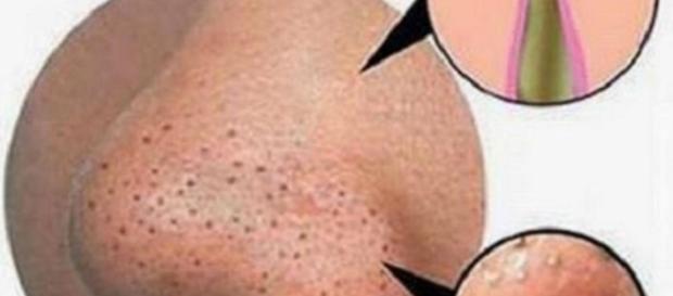 Nunca vas a tener una espinilla de nuevo después de ver esto esta ... - pinterest.com Nunca vas a tener una espinilla de nuevo después de ver esto esta ... - pinterest.com