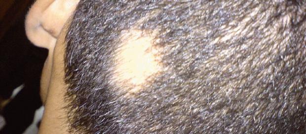 Causas y tratamiento de la Alopecia areata - institutodelpelo.es Causas y tratamiento de la Alopecia areata - institutodelpelo.es