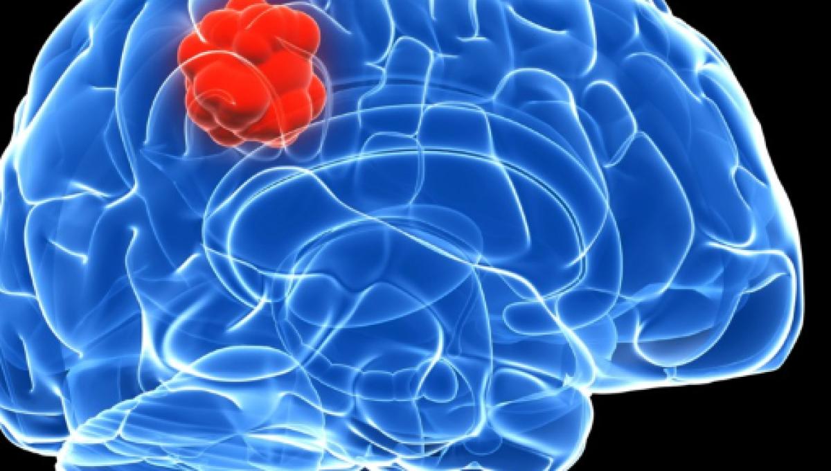 Como saber si una persona tiene un tumor cerebral