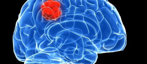 Los tumores cerebrales están afectando a más personas