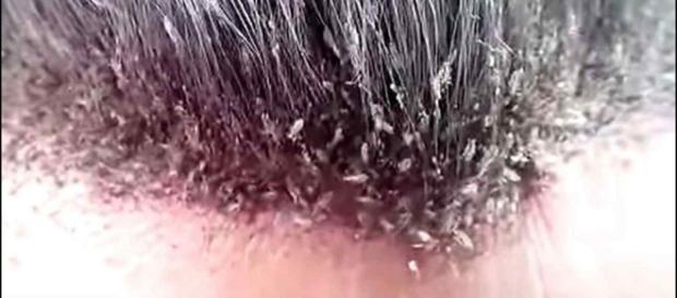 Qué remedios caseros para los piojos puedo utilizar? - remediosyhomeopatia.com Qué remedios caseros para los piojos puedo utilizar? - remediosyhomeopatia.com