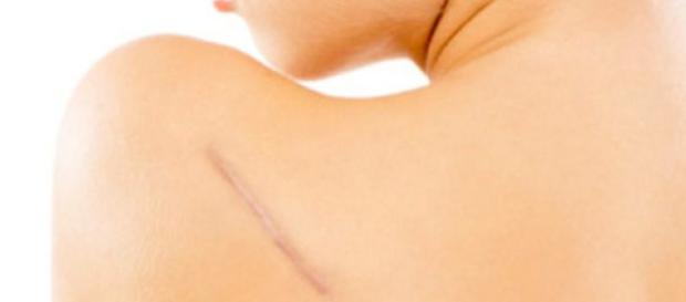 cicatrices en la piel? : Su Médico - sumedico.com cicatrices en la piel? : Su Médico - sumedico.com