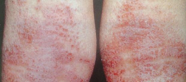 Confira como tratar de forma eficaz a dermatite e a psoríase Confira como tratar de forma eficaz a dermatite e a psoríase