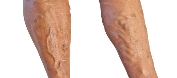 Tratamiento variculas en Valencia. Diagnostico y tratamiento varices - clinicaserrano.com Tratamiento variculas en Valencia. Diagnostico y tratamiento varices - clinicaserrano.com