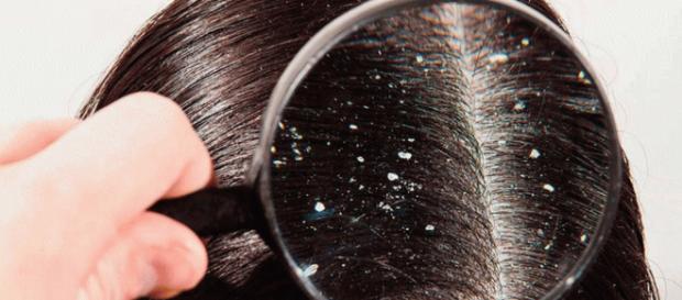 VUELVE A SENTIR CONFIANZA! Remedios naturales contra la caspa y la ... - noticiaalminuto.com VUELVE A SENTIR CONFIANZA! Remedios naturales contra la caspa y la ... - noticiaalminuto.com