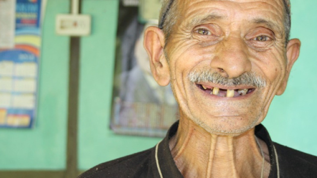 Denti e Alzheimer, le cose da sapere