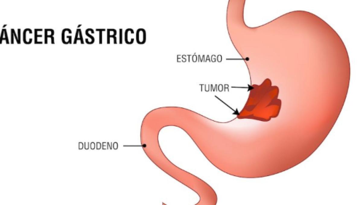 Alimentos prohibidos helicobacter pylori