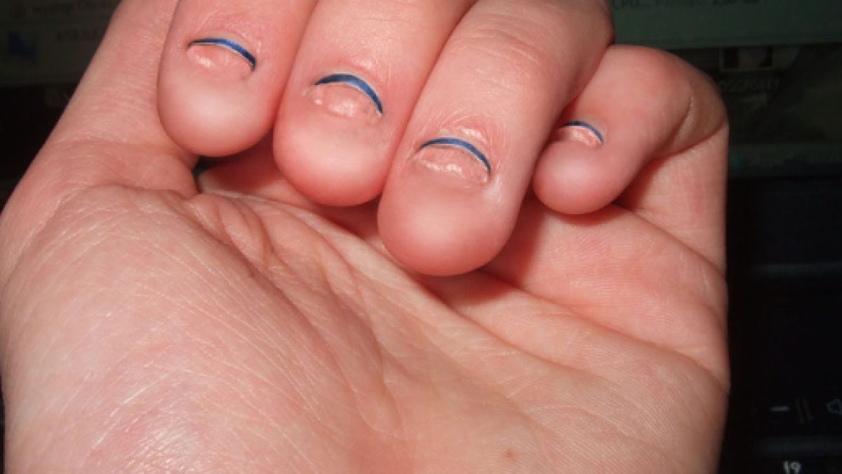 Man almost dies from biting his fingernails Man almost dies from biting his fingernails