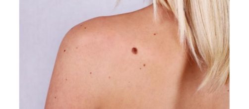 'Día mundial contra el melanoma': eclipsando al cáncer de piel