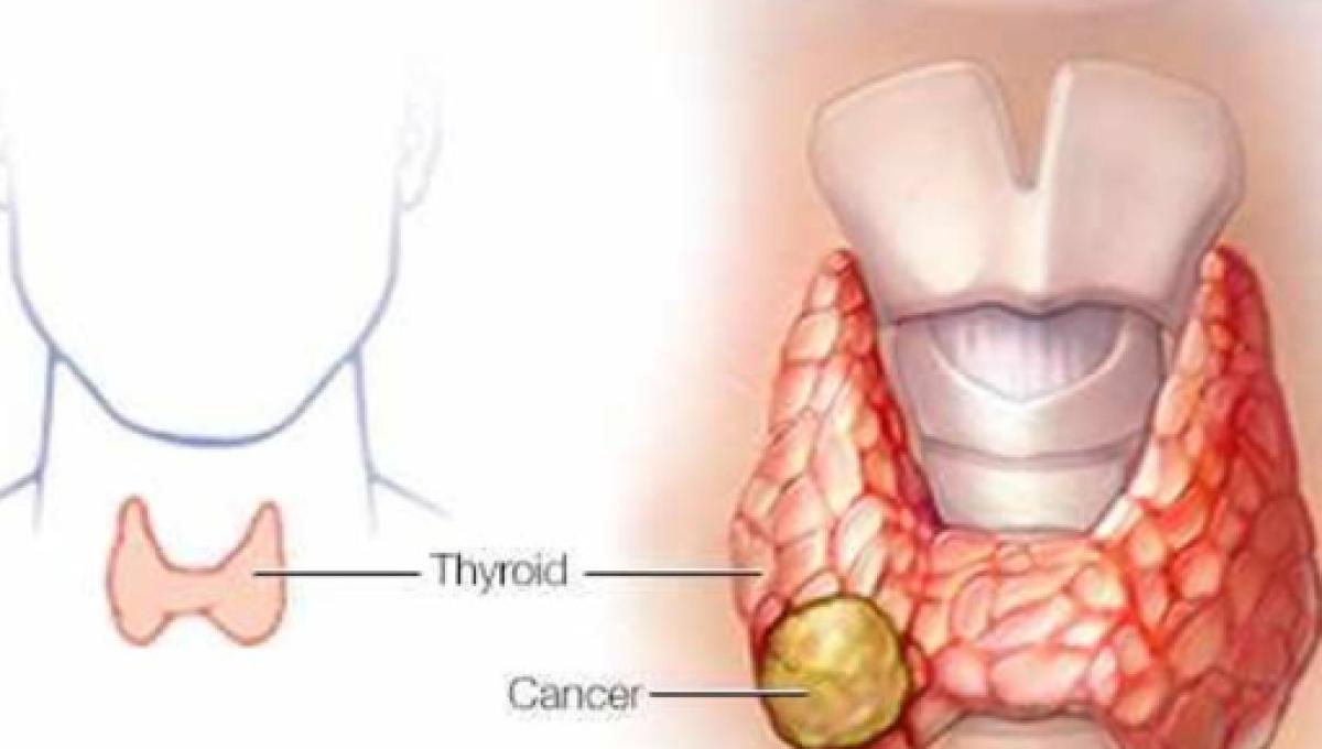 sintomas de tiroides alta en hombres