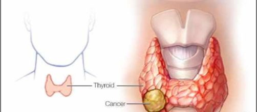 La mayoría de los pacientes con cáncer de tiroides se curan ... - giraenlared.com