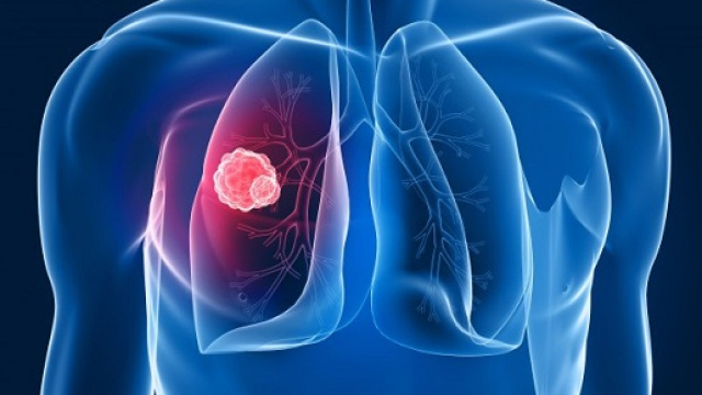 Tumore al polmone, allarme tra le donne: sono pi&ugrave; colpite degli uomini