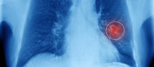 Rivoluzione nella cura del tumore al polmone