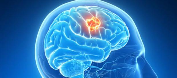 Mecanismo clave en formación de tumores cerebrales | Cáncer ... - com.uy Mecanismo clave en formación de tumores cerebrales | Cáncer ... - com.uy