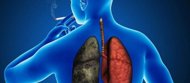 El cáncer de pulmón sigue su desconocido y "desalentador" avance ... - com.mx El cáncer de pulmón sigue su desconocido y "desalentador" avance ... - com.mx