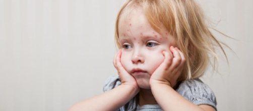 Sarampión en niños: causas, síntomas y tratamiento