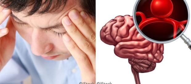 Síntomas de un Aneurisma cerebral y factores de riesgo a tomar en cuenta Síntomas de un Aneurisma cerebral y factores de riesgo a tomar en cuenta
