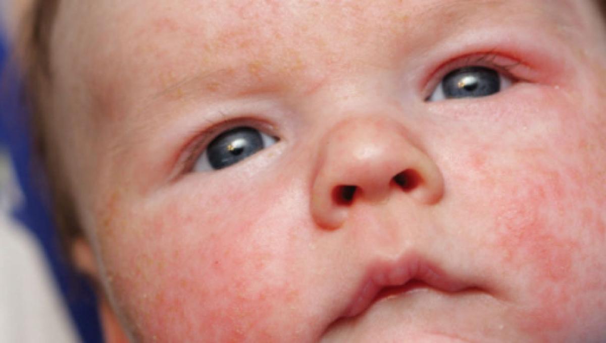 Alimentos para dermatitis atopica