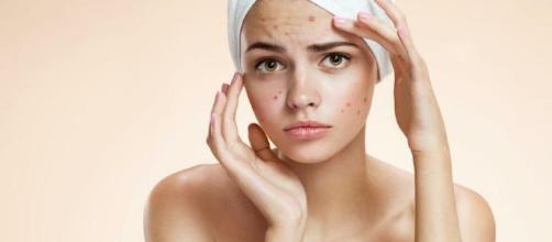 Los mejores consejos para combatir el acné
