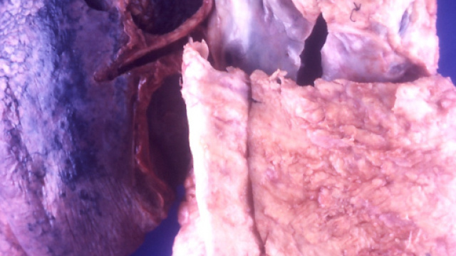 Cancro ai polmoni ( Ph. Wikimedia Commons - Yale Rosen)