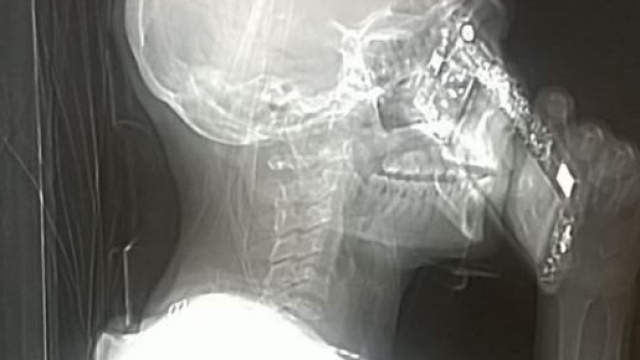 La foto che impazza sui social &egrave; delle signora che, durante la Tac, ha risposto al telefono.