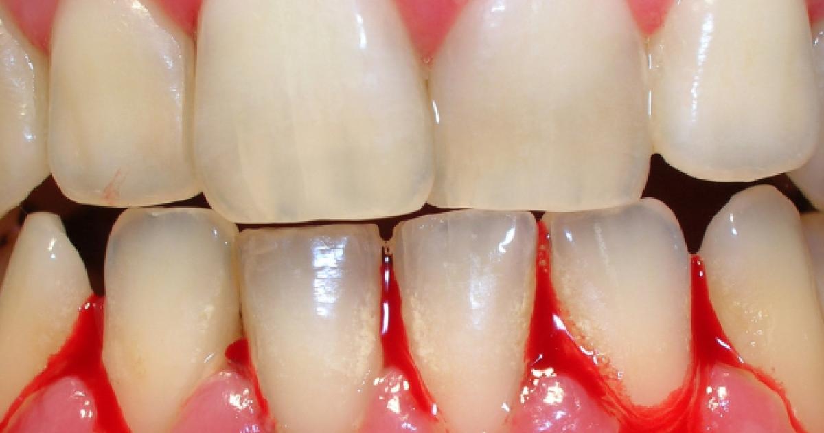 ¿Por qué nos sangran las encías?