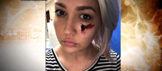 Singer Meghan Linsey explains horrific venomous spider bite on her go.com Singer Meghan Linsey explains horrific venomous spider bite on her go.com
